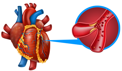 Inflammation