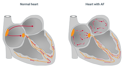 Understanding atrial enlargement to prevent atrial fibrillation