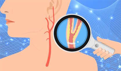 A persons neck with a magnifying glass showing a blocked artery