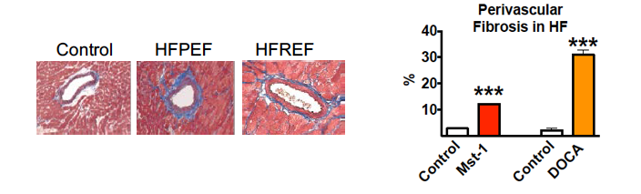 Causes, effects and treatment of cardiac fibrosis