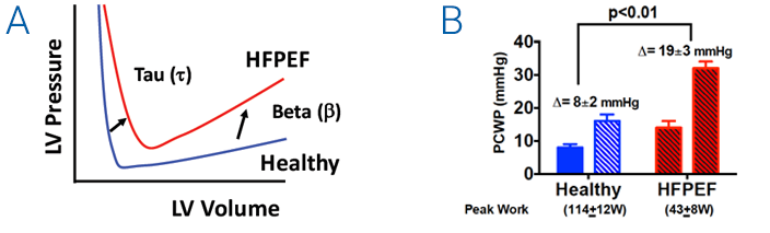 Heart Failure with preserved pump function