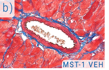 Novel treatments for obesity related hypertension - B