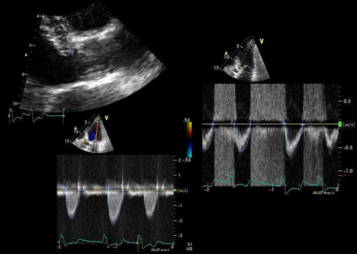 Aortic stenosis history osce image