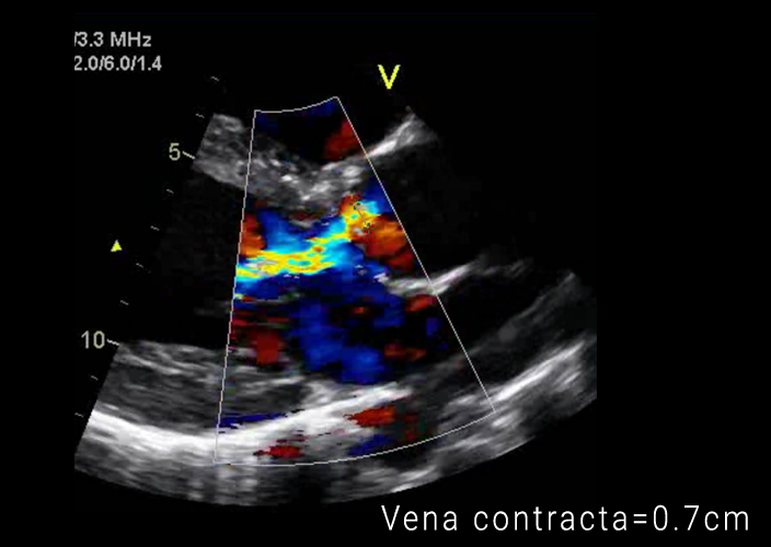 Apical impulse in aortic stenosis image